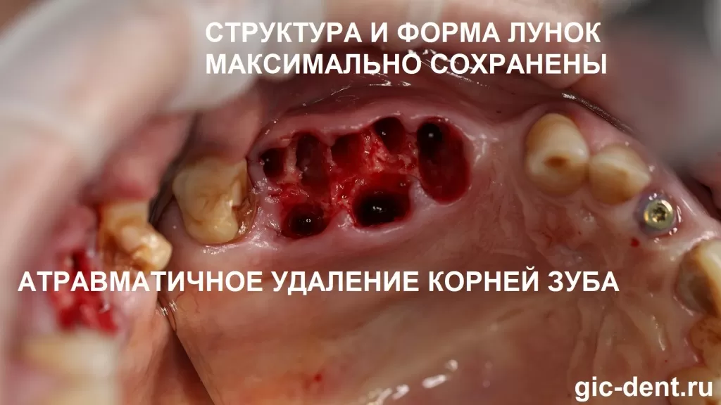  удаление зуба, удаление зуба мудрости, ретинированного зуба или корня зуба должно проводиться максимально атравматично, максимально сохраняя структуру тканей, которые окружают зуб или корень зуба. Хирург имплантолог Дахкильгов Магомед Уматгиреевич , Немецкий имплантологический центр, Москва
